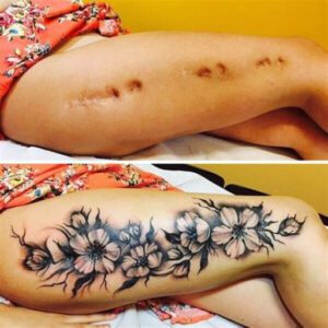 Tattoo Ideas for Scars on Legs