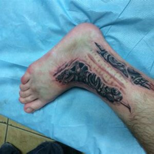 Ankle Surgery Ankle Scar Tattoo Ideas