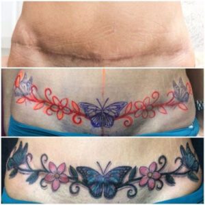 Tattoo Ideas for Tummy Tuck Scars